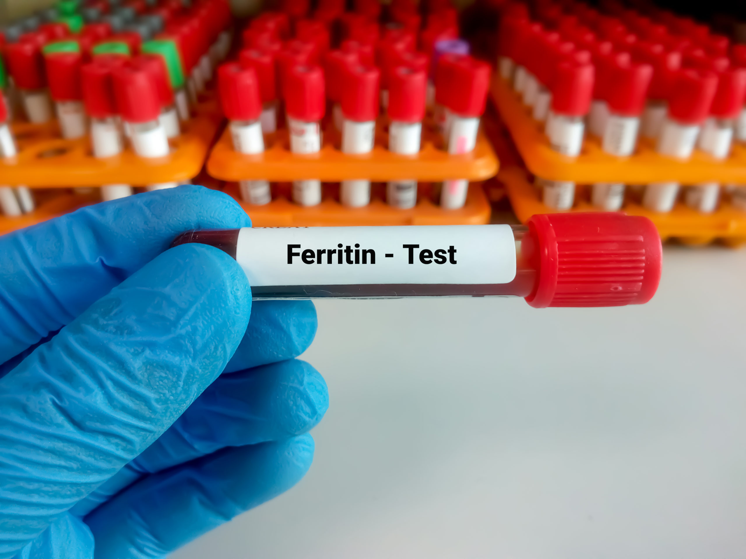 A clinician wearing gloves holding a small blood collection tube near a lab requisition form, suggesting testing for iron and ferritin