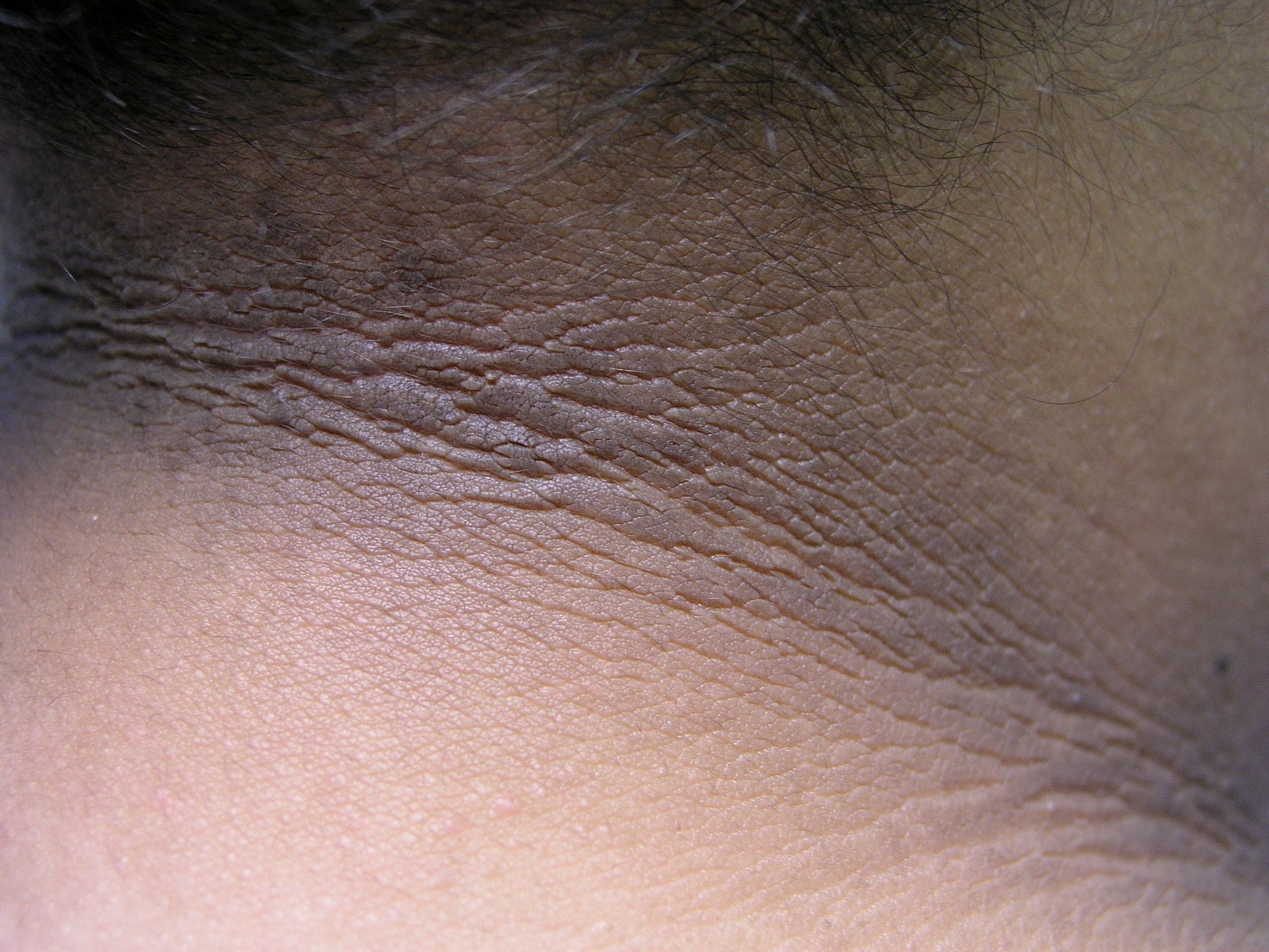 A close view of the back of a person's neck showing a darker, velvety band of skin consistent with insulin resistance