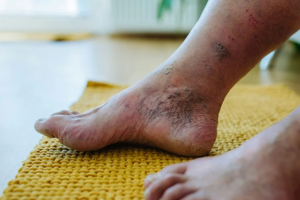 An adult sitting on the edge of a bed, gently holding one foot with a concerned expression, suggesting tingling or numbness in the toes