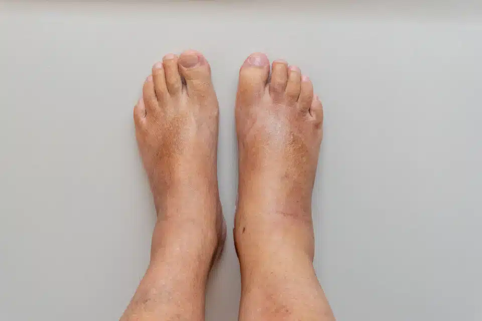 Swollen Ankles and Feet: Common Causes and When to See a Doctor