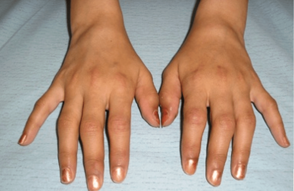 Hands resting on a table with visible puffiness around the knuckles, suggesting inflammatory joint swelling